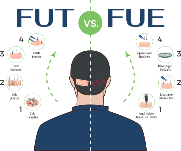 เทคนิคปลูกผม FUT และ FUE