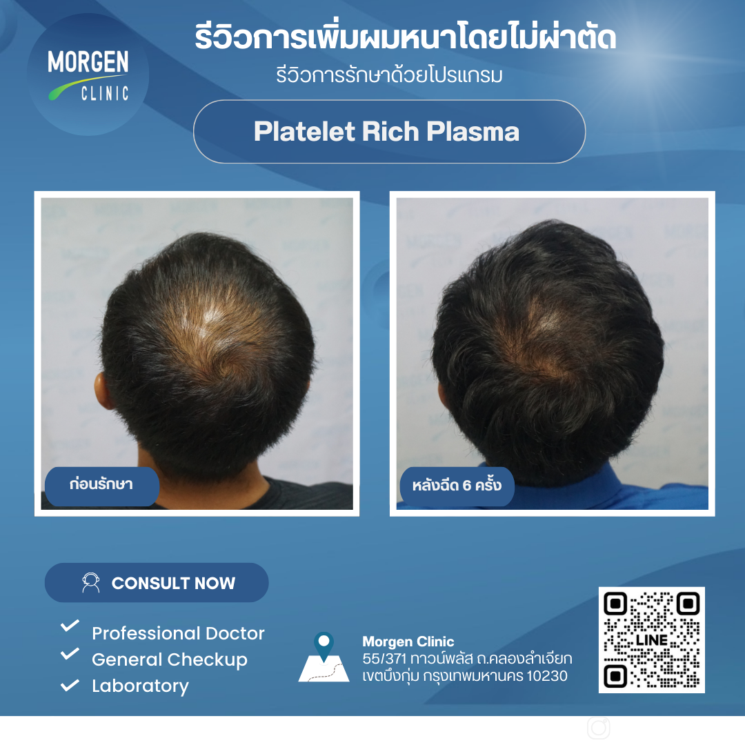 รีวิวผมหนา ไม่ต้องผ่าตัด