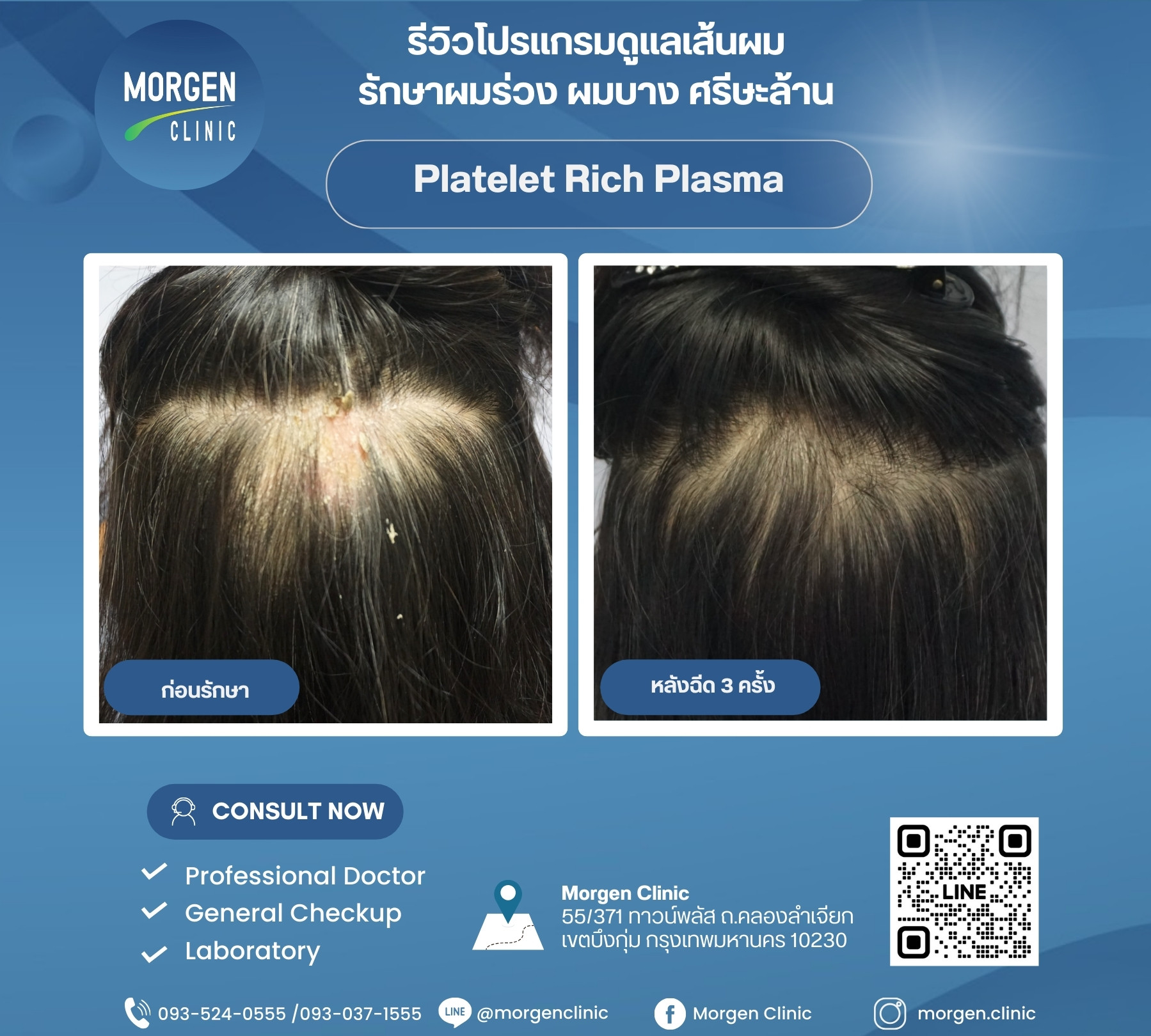 รีวิวผมหนา ไม่ต้องผ่าตัด