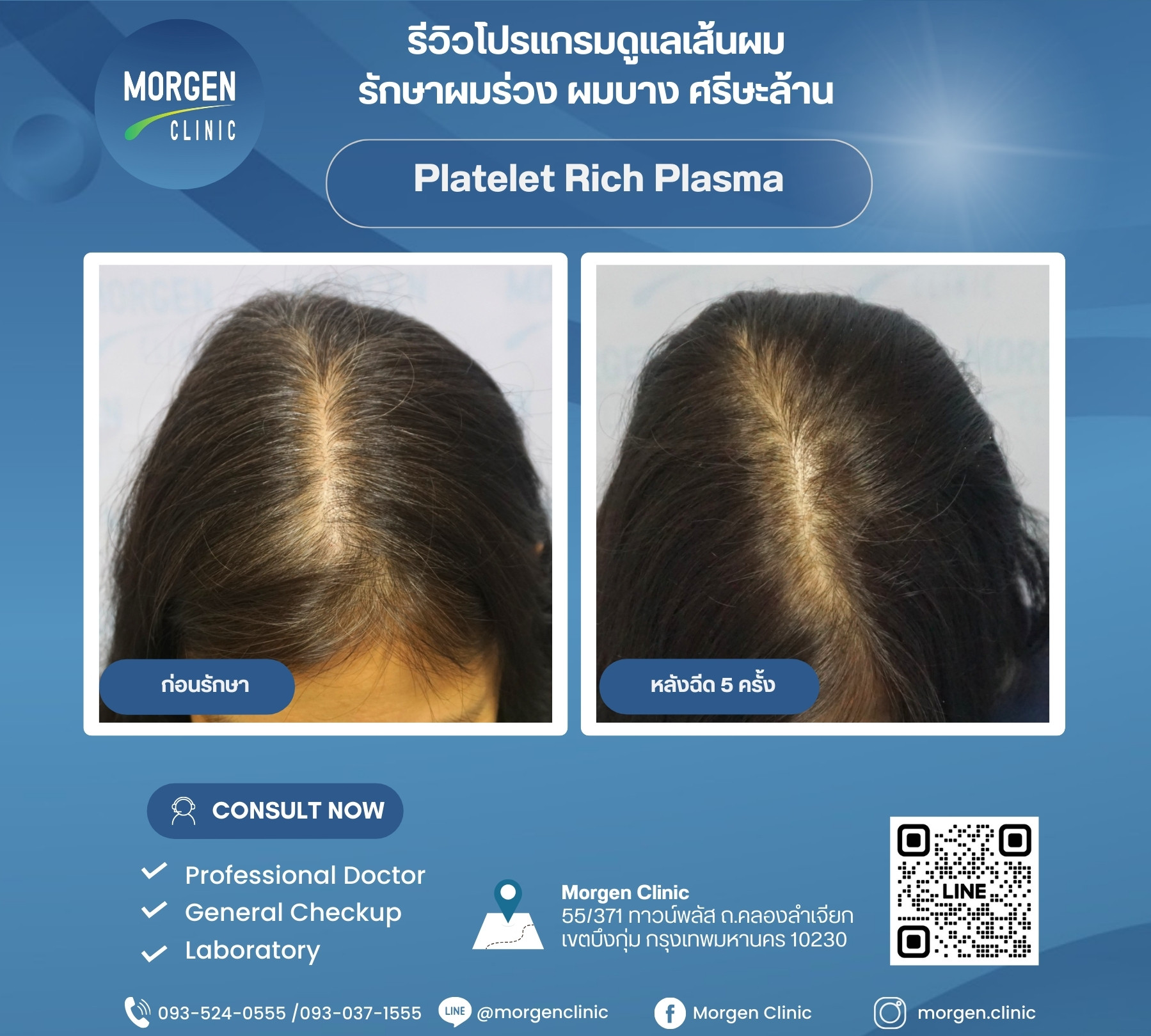 รีวิวผมหนา ไม่ต้องผ่าตัด