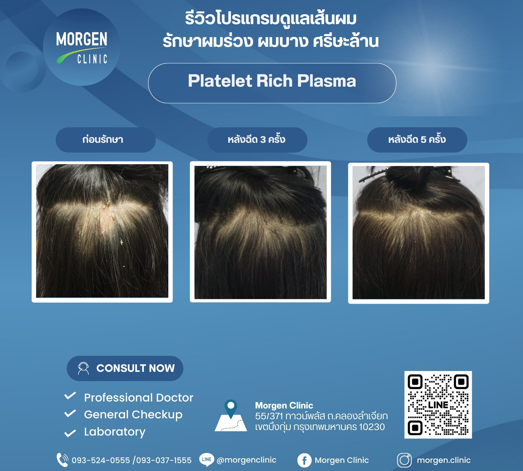 รีวิวผมหนา ไม่ต้องผ่าตัด
